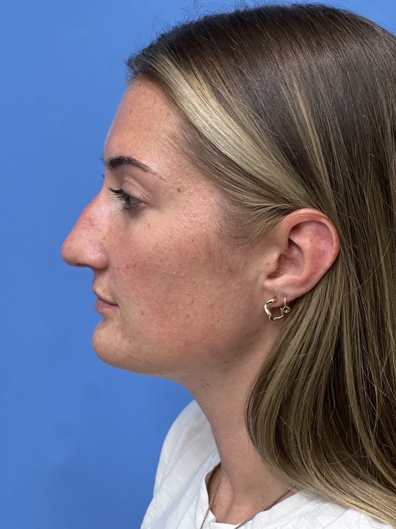 Rhinoplasty Before & After Gallery - Patient 366367 - Image 1