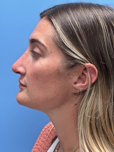 Rhinoplasty Before & After Gallery - Patient 366367 - Image 2