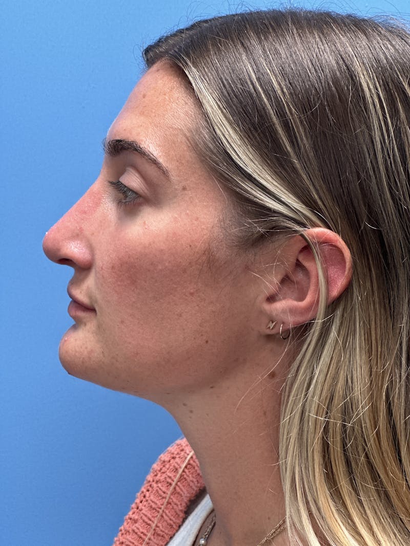 Rhinoplasty Before & After Gallery - Patient 366367 - Image 2