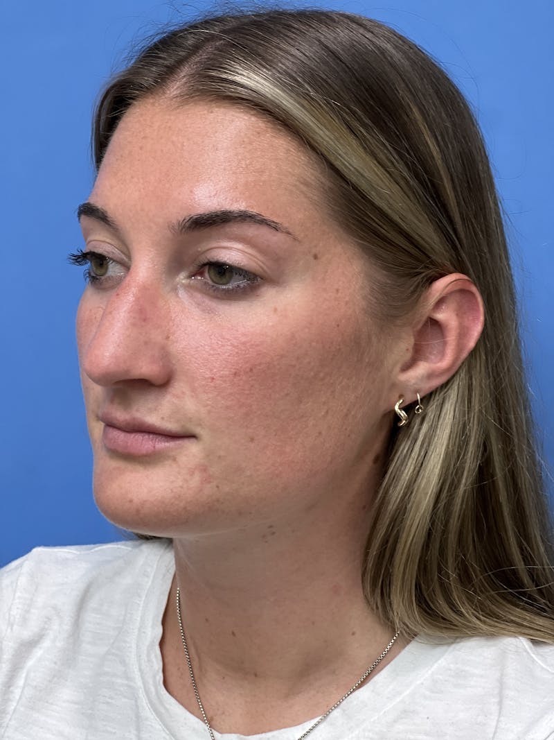 Rhinoplasty Before & After Gallery - Patient 366367 - Image 3