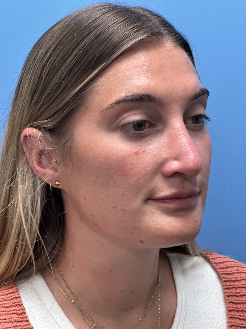 Rhinoplasty Before & After Gallery - Patient 366367 - Image 4