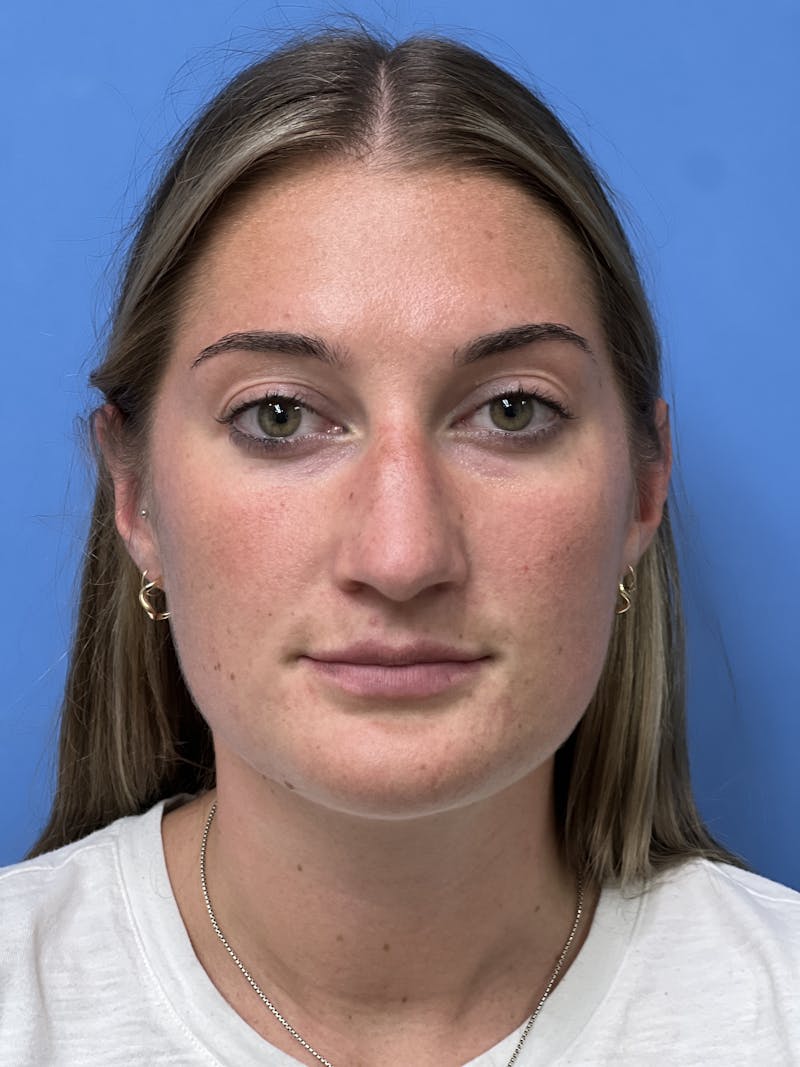 Rhinoplasty Before & After Gallery - Patient 366367 - Image 5