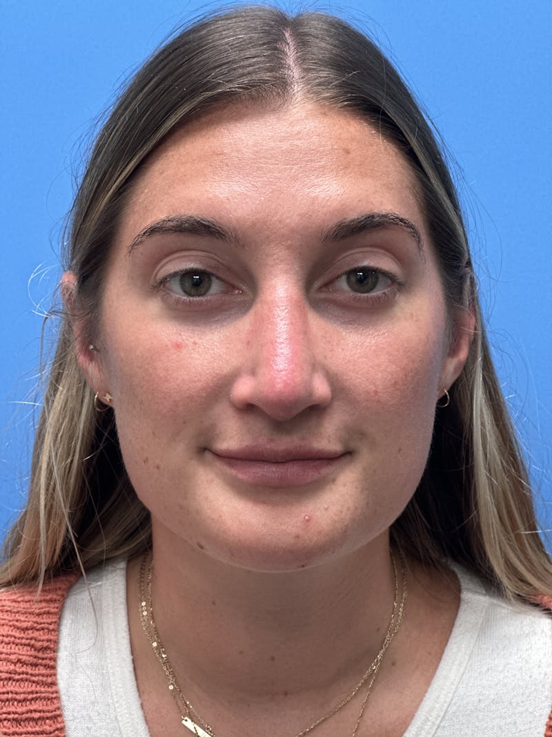 Rhinoplasty Before & After Gallery - Patient 366367 - Image 6