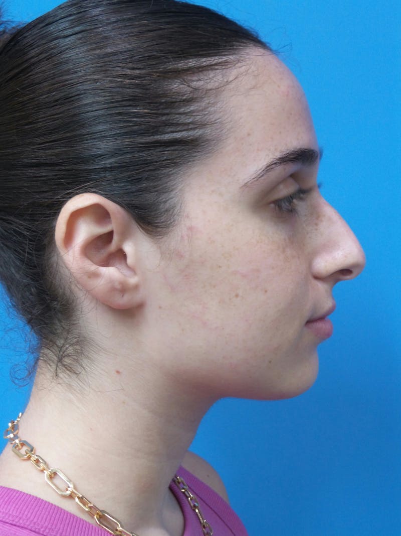 Rhinoplasty Before & After Gallery - Patient 142141 - Image 1