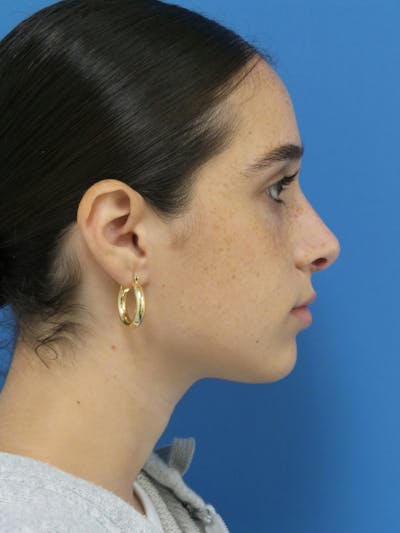 Rhinoplasty Before & After Gallery - Patient 142141 - Image 2