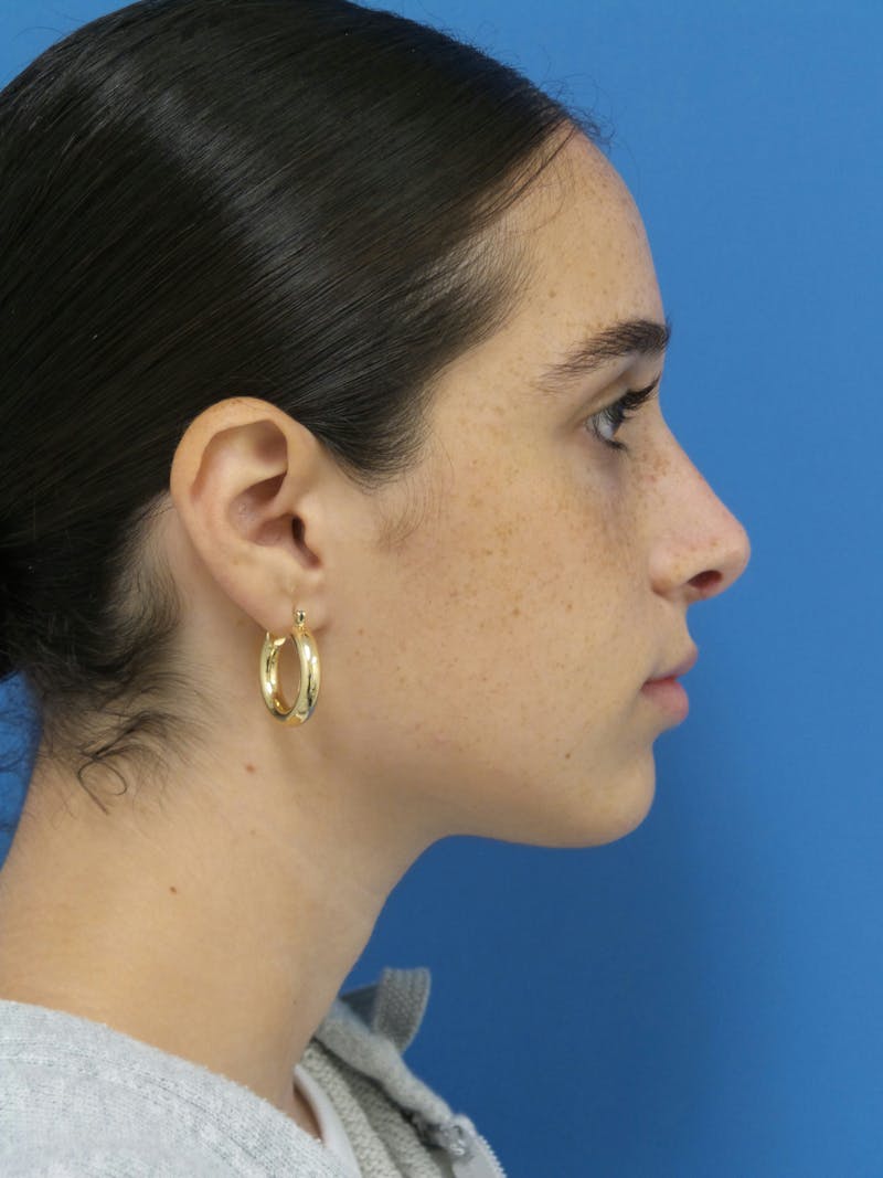 Rhinoplasty Before & After Gallery - Patient 142141 - Image 2