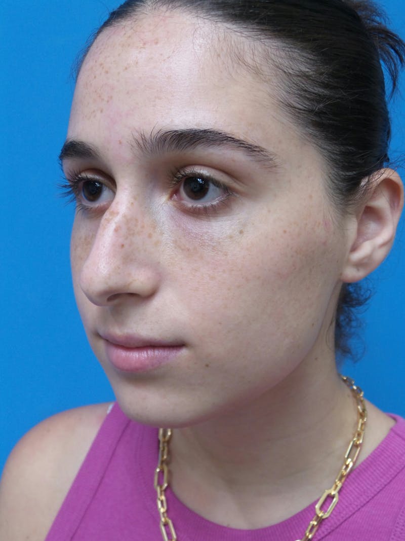 Rhinoplasty Before & After Gallery - Patient 142141 - Image 3