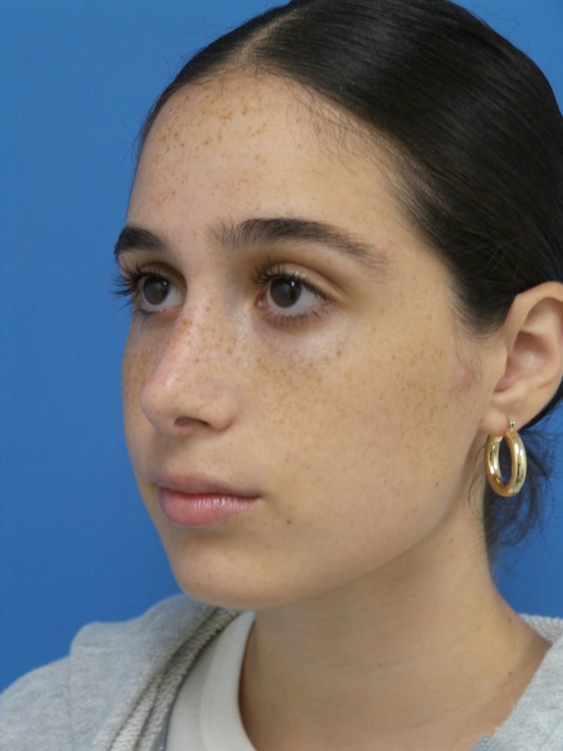 Rhinoplasty Before & After Gallery - Patient 142141 - Image 4