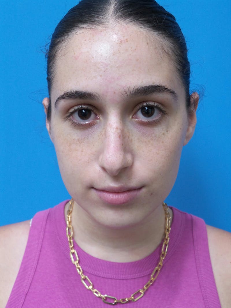 Rhinoplasty Before & After Gallery - Patient 142141 - Image 5