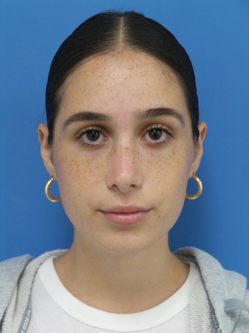 Rhinoplasty Before & After Gallery - Patient 142141 - Image 6