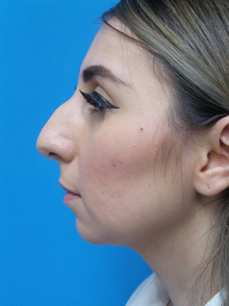 Rhinoplasty Before & After Gallery - Patient 133389 - Image 1