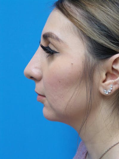 Rhinoplasty Before & After Gallery - Patient 133389 - Image 2