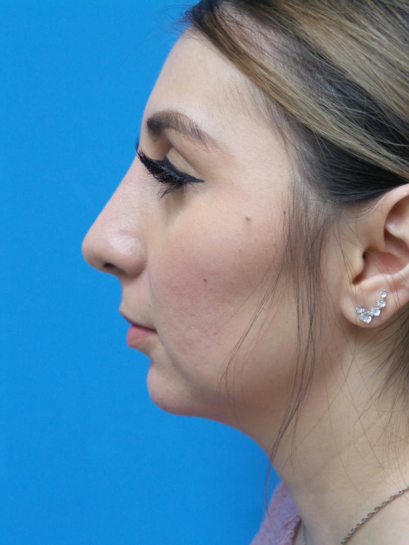 Rhinoplasty Before & After Gallery - Patient 133389 - Image 2