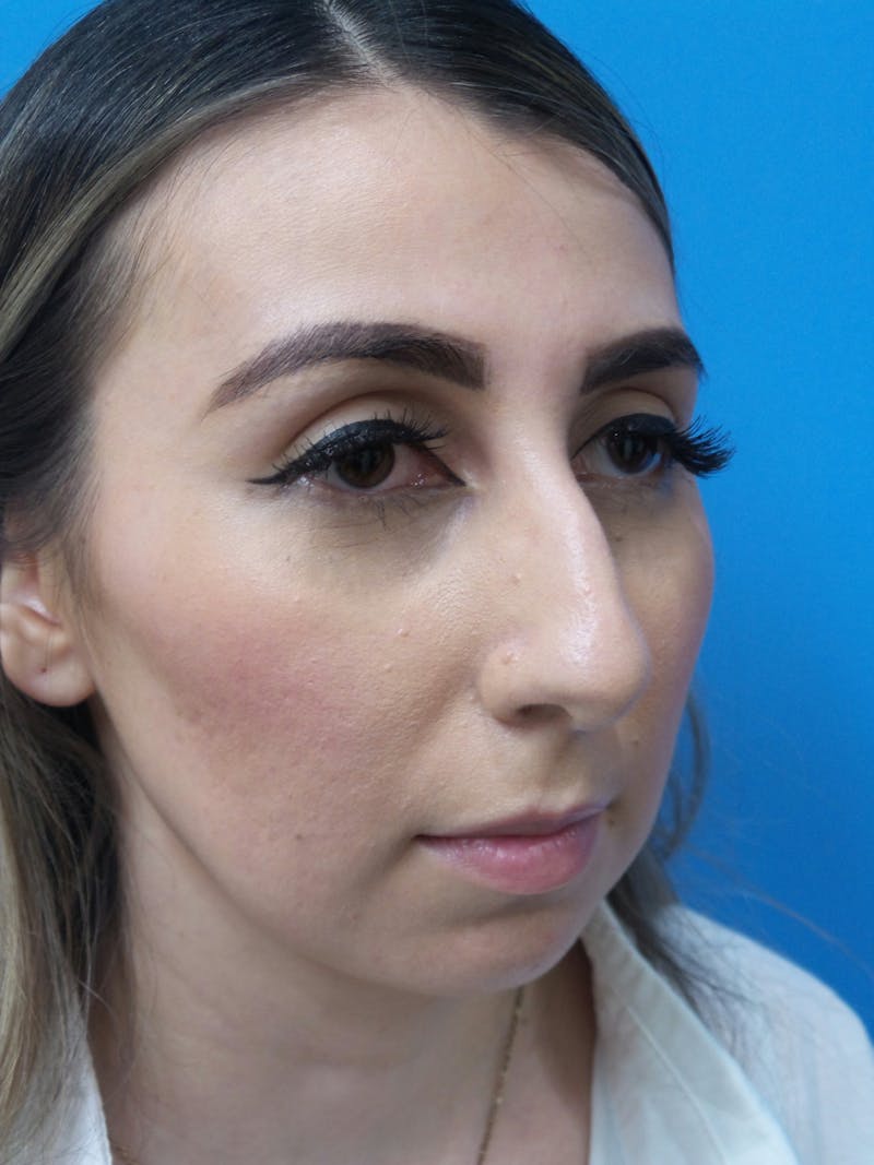 Rhinoplasty Before & After Gallery - Patient 133389 - Image 3
