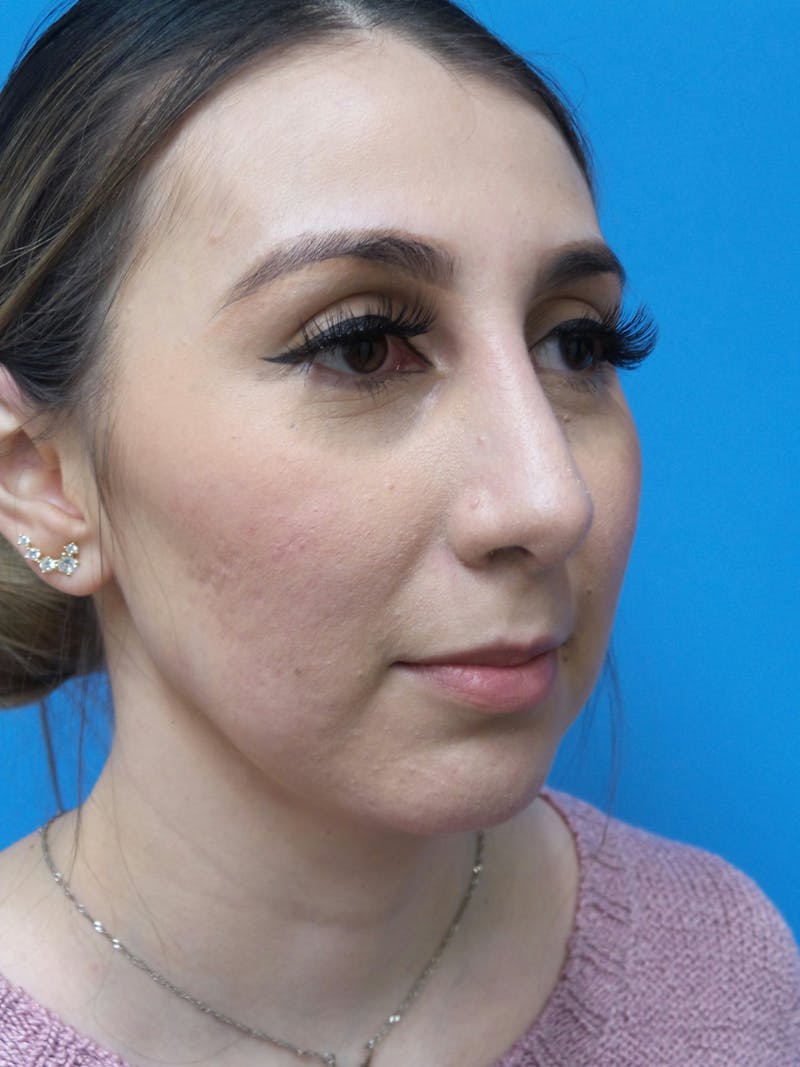 Rhinoplasty Before & After Gallery - Patient 133389 - Image 4