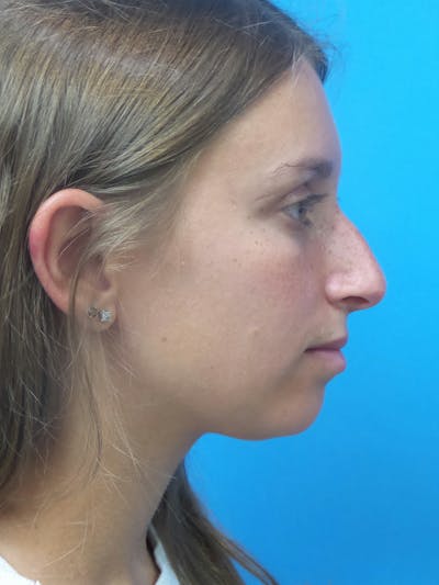 Rhinoplasty Before & After Gallery - Patient 402813 - Image 1