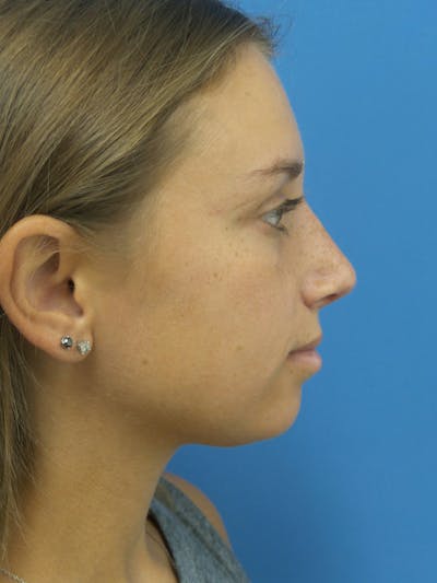 Rhinoplasty Before & After Gallery - Patient 402813 - Image 2