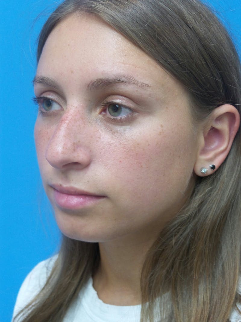 Rhinoplasty Before & After Gallery - Patient 402813 - Image 3