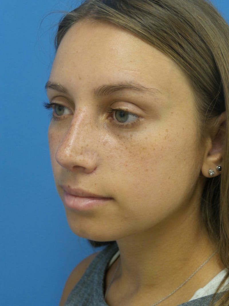Rhinoplasty Before & After Gallery - Patient 402813 - Image 4
