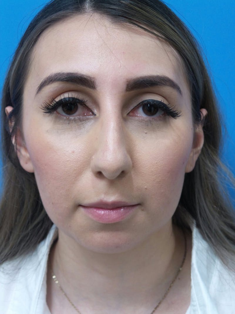 Rhinoplasty Before & After Gallery - Patient 133389 - Image 5