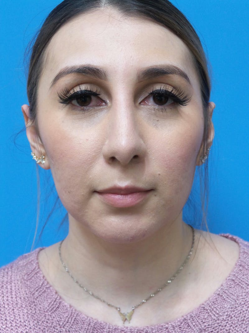 Rhinoplasty Before & After Gallery - Patient 133389 - Image 6