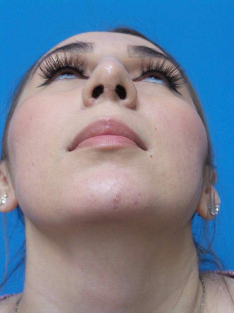 Rhinoplasty Before & After Gallery - Patient 133389 - Image 8