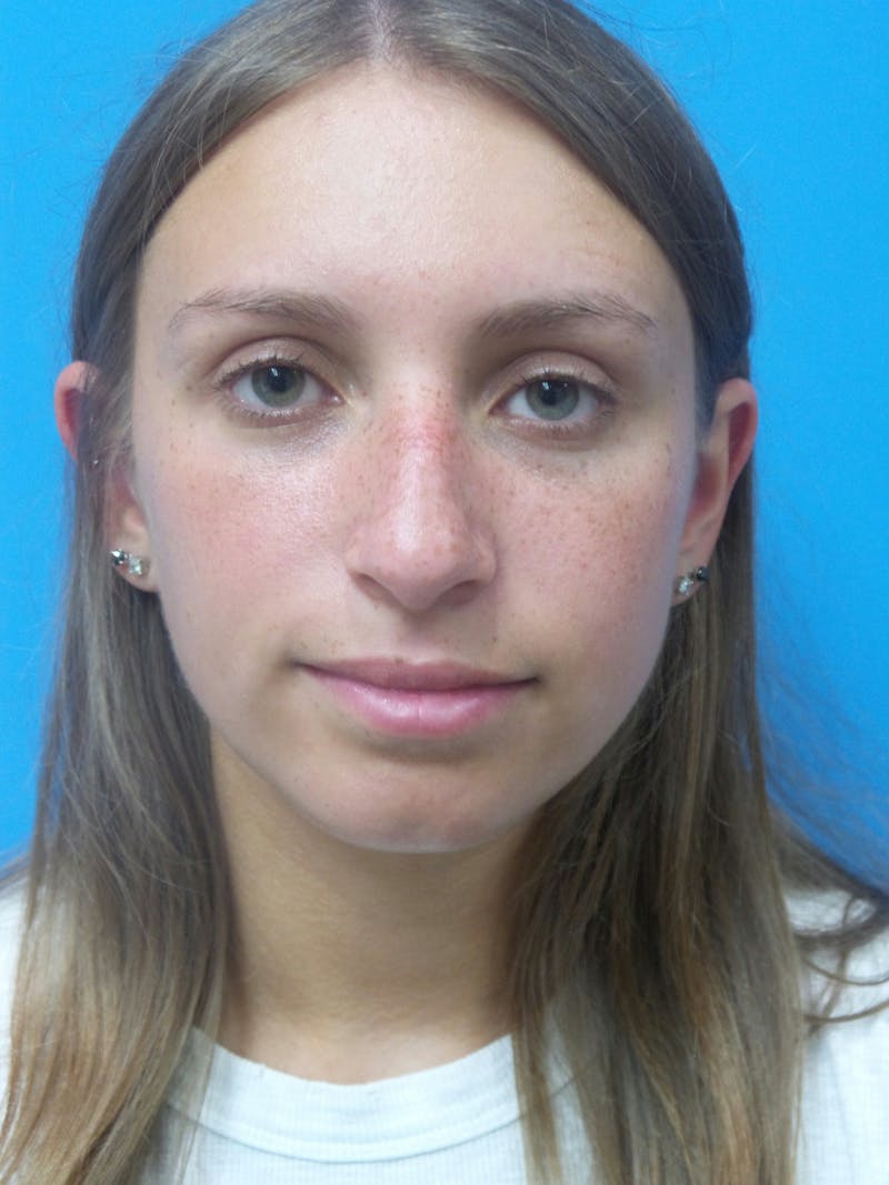 Rhinoplasty Before & After Gallery - Patient 402813 - Image 5