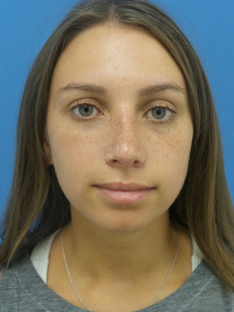 Rhinoplasty Before & After Gallery - Patient 402813 - Image 6