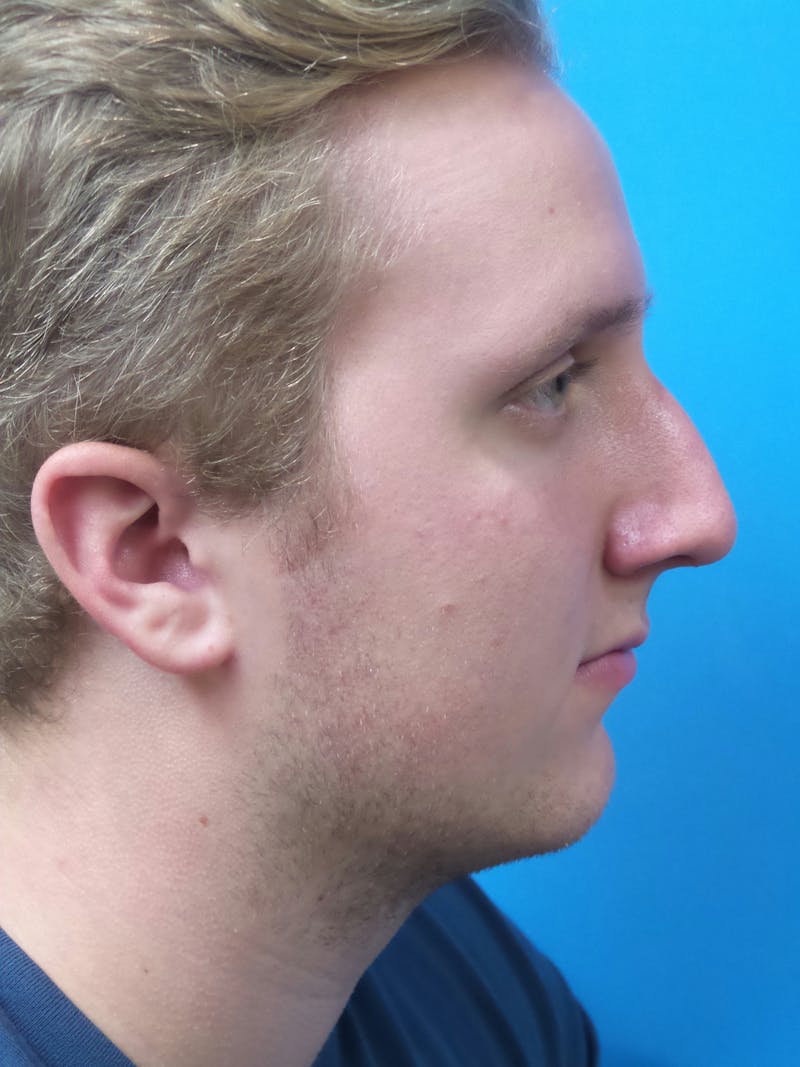Rhinoplasty Before & After Gallery - Patient 162553 - Image 1