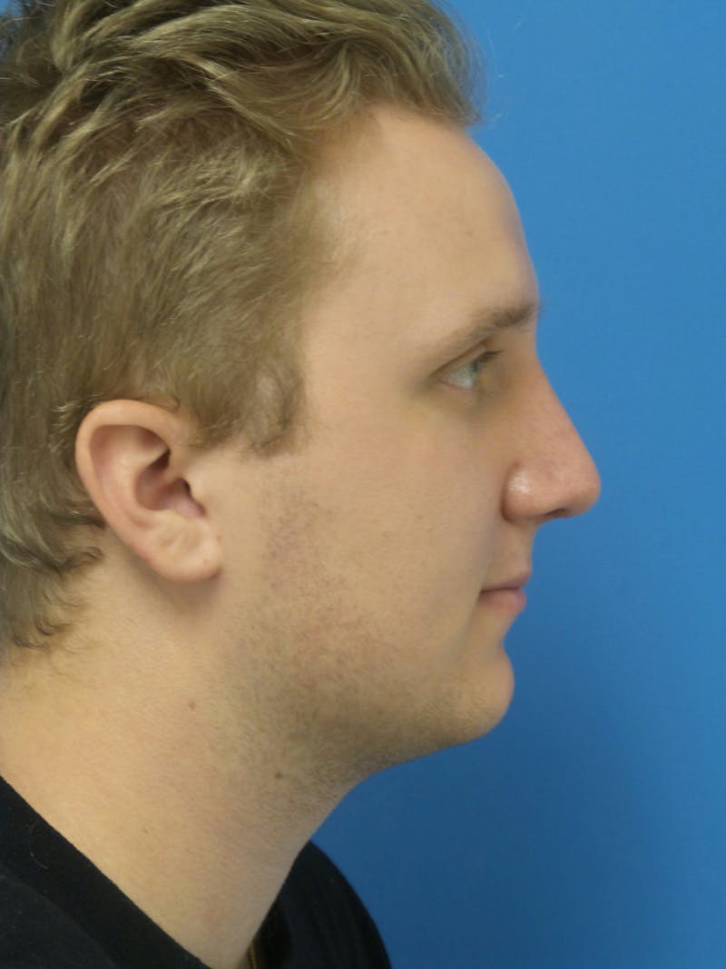 Rhinoplasty Before & After Gallery - Patient 162553 - Image 2