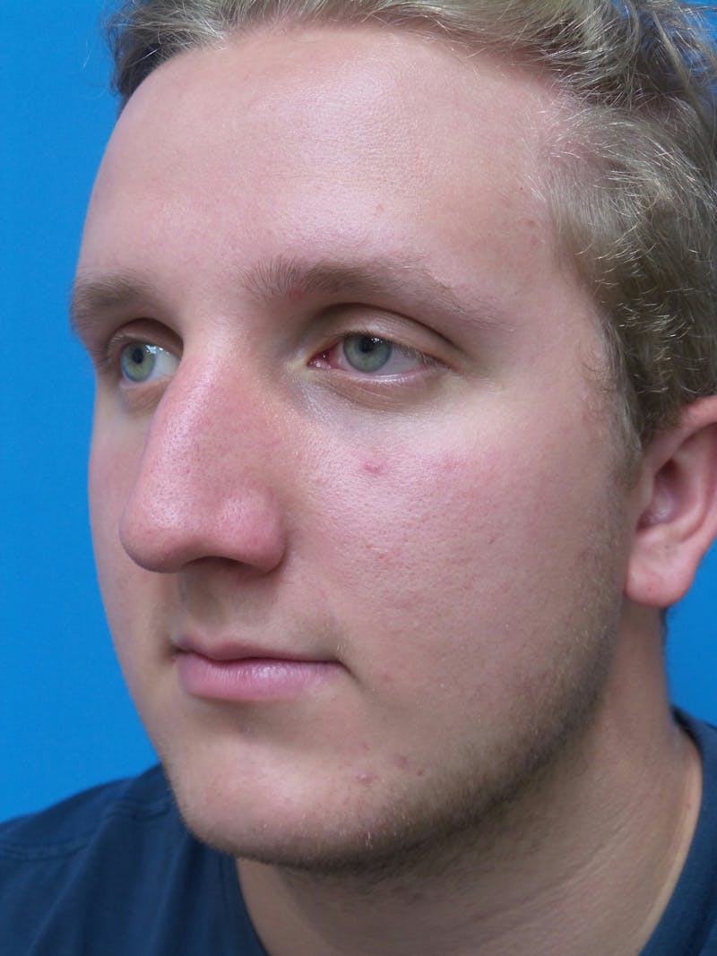 Rhinoplasty Before & After Gallery - Patient 162553 - Image 3