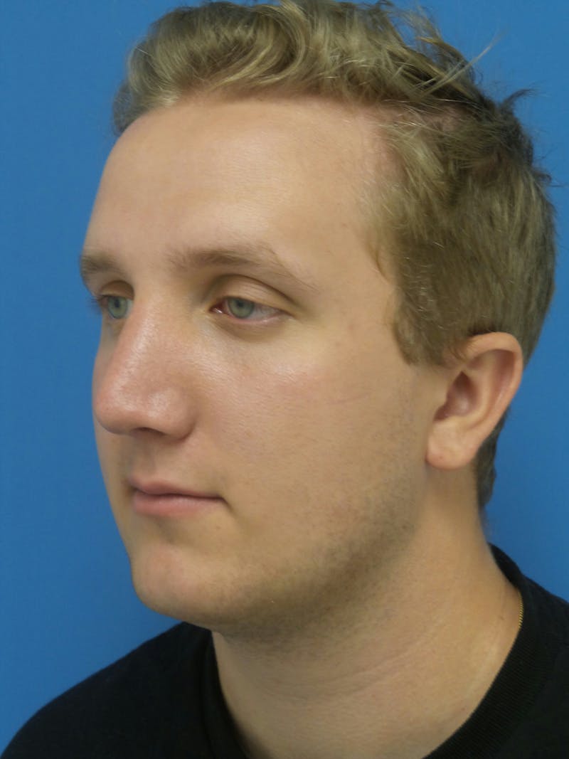 Rhinoplasty Before & After Gallery - Patient 162553 - Image 4