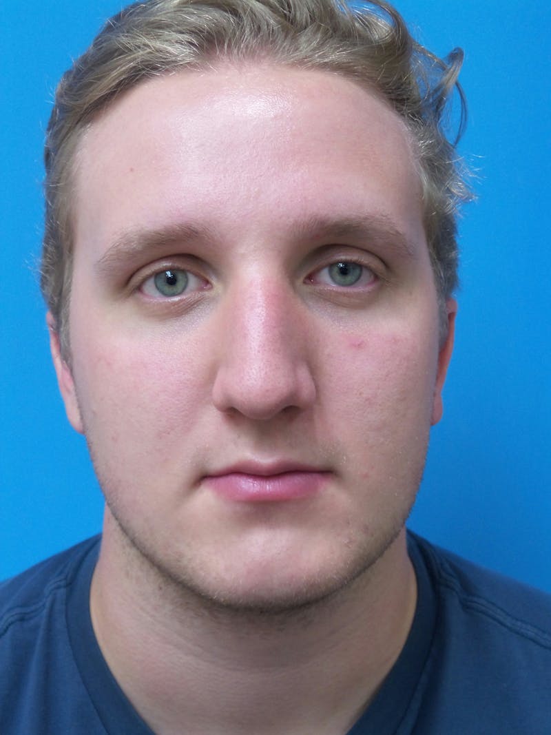 Rhinoplasty Before & After Gallery - Patient 162553 - Image 5