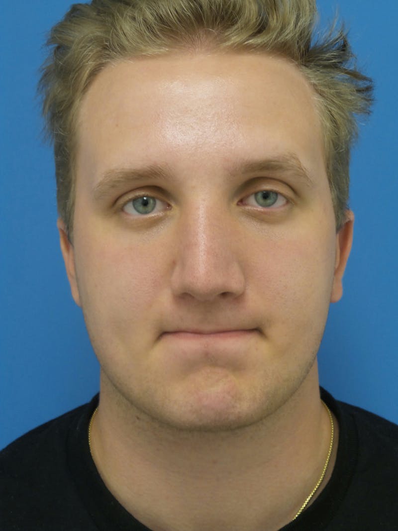 Rhinoplasty Before & After Gallery - Patient 162553 - Image 6