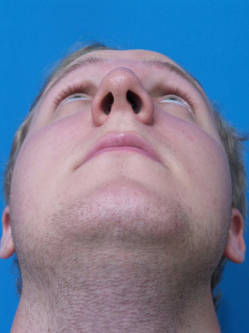 Rhinoplasty Before & After Gallery - Patient 162553 - Image 7