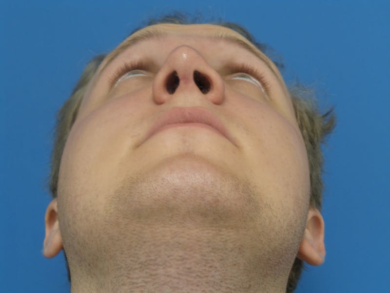 Rhinoplasty Before & After Gallery - Patient 162553 - Image 8