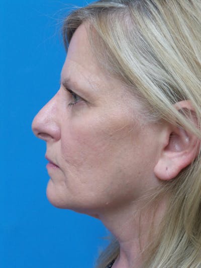 Rhinoplasty Before & After Gallery - Patient 138344 - Image 1