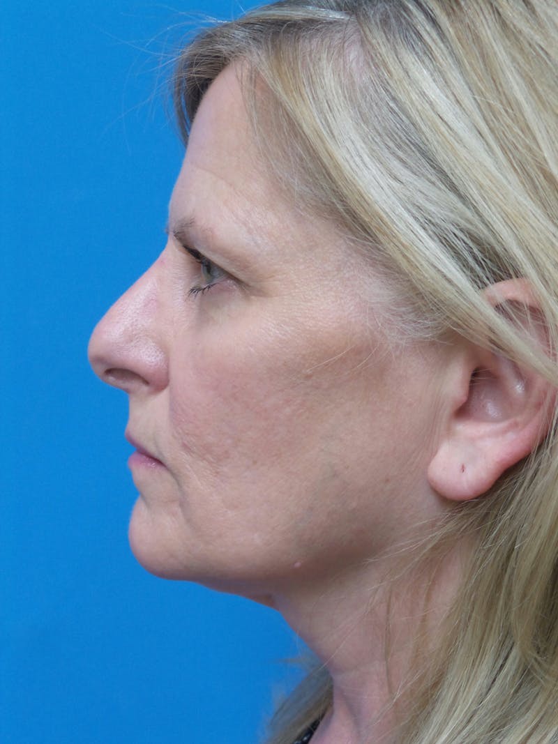 Rhinoplasty Before & After Gallery - Patient 138344 - Image 1