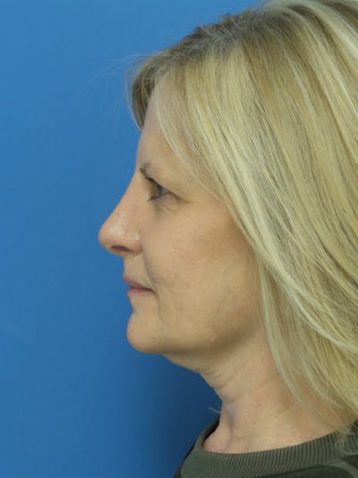 Rhinoplasty Before & After Gallery - Patient 138344 - Image 2