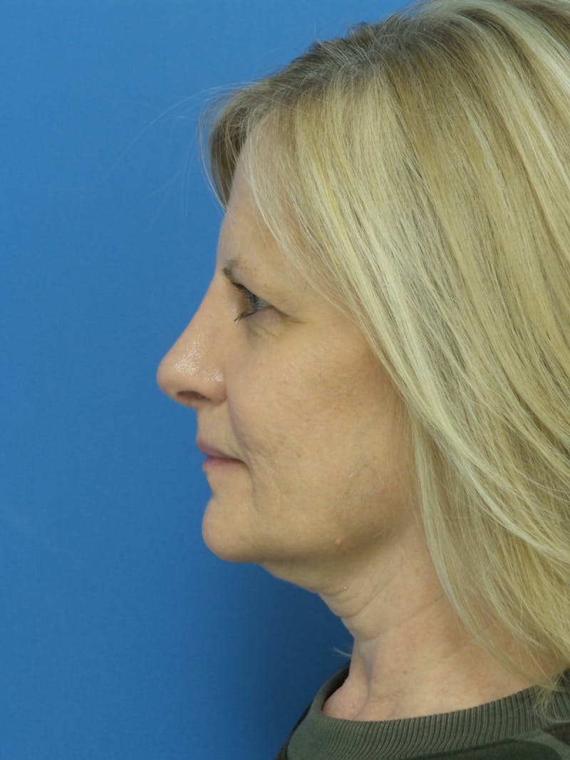 Rhinoplasty Before & After Gallery - Patient 138344 - Image 2