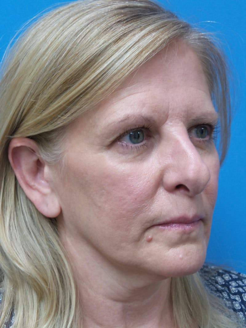 Rhinoplasty Before & After Gallery - Patient 138344 - Image 3