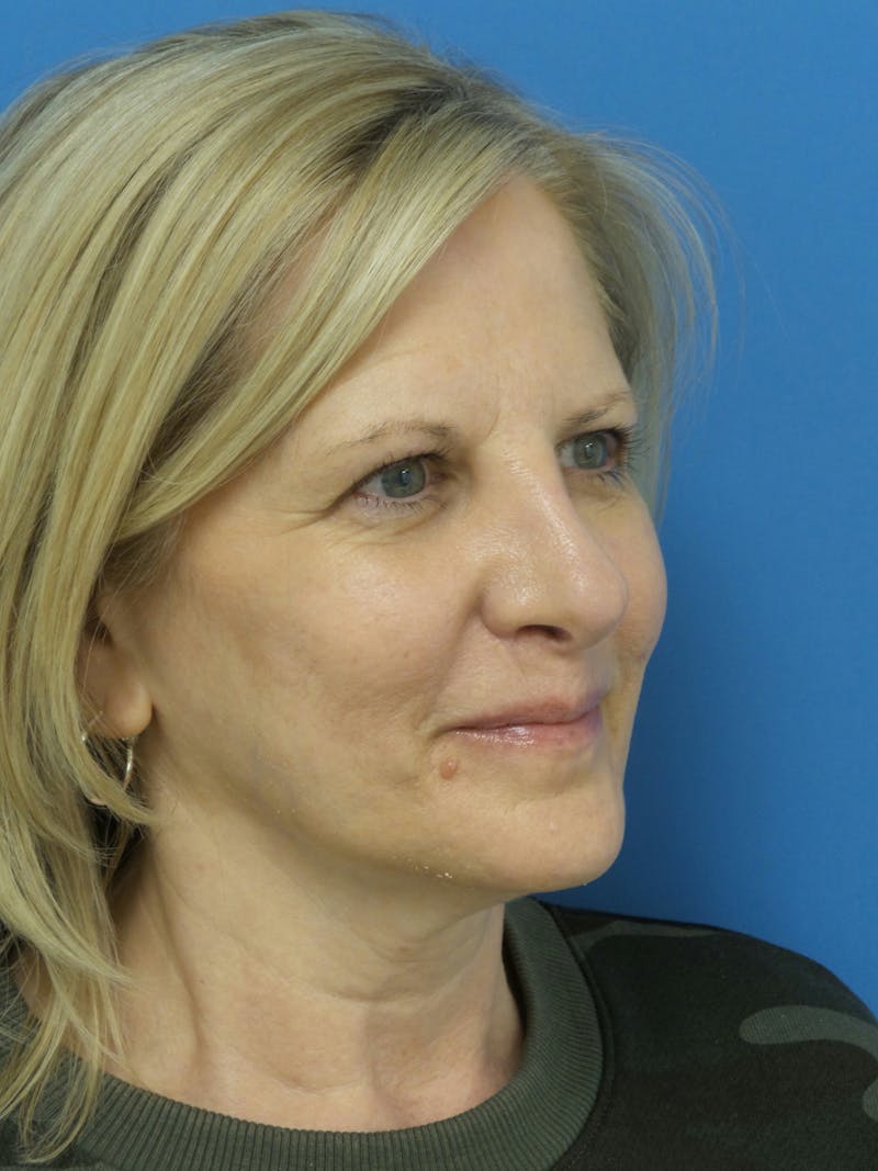 Rhinoplasty Before & After Gallery - Patient 138344 - Image 4