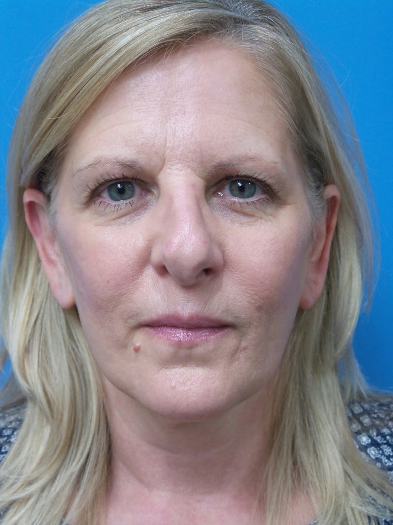 Rhinoplasty Before & After Gallery - Patient 138344 - Image 5