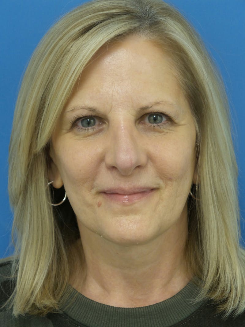 Rhinoplasty Before & After Gallery - Patient 138344 - Image 6