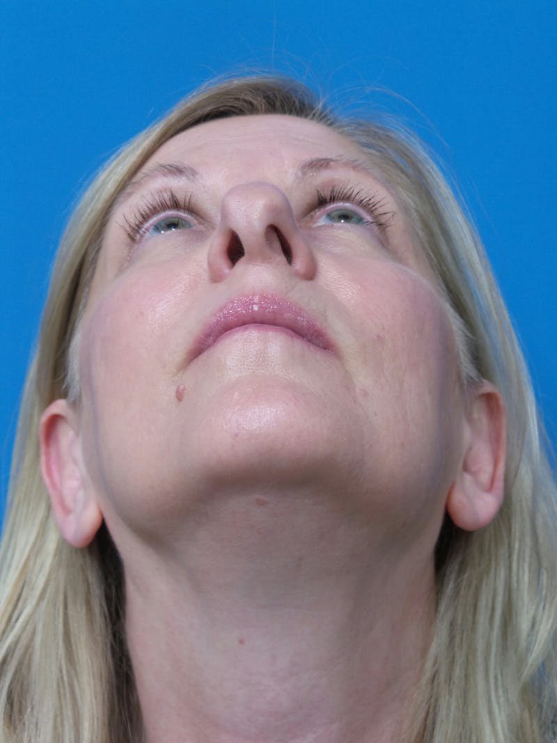 Rhinoplasty Before & After Gallery - Patient 138344 - Image 7