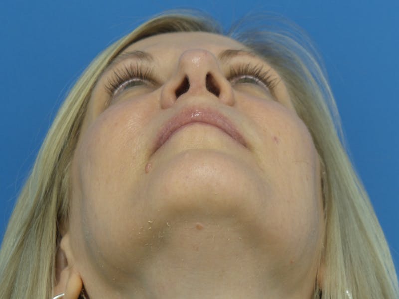 Rhinoplasty Before & After Gallery - Patient 138344 - Image 8