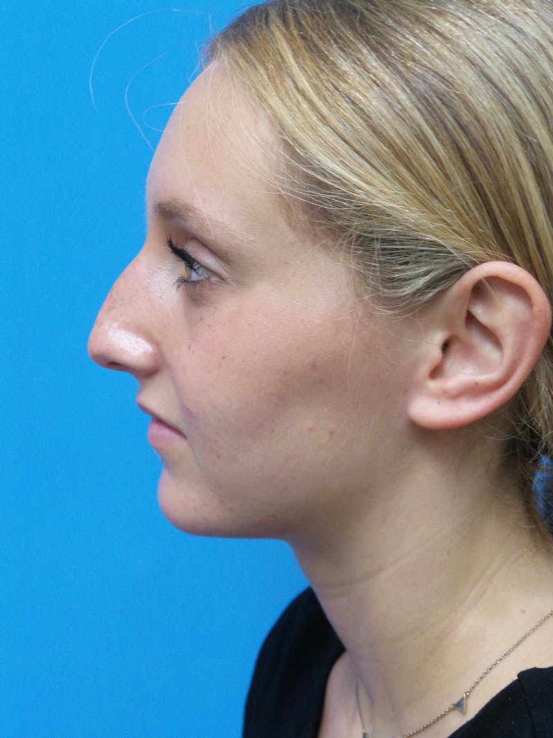 Rhinoplasty Before & After Gallery - Patient 178538 - Image 1