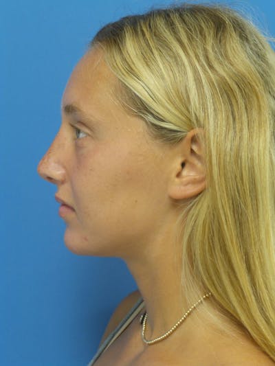Rhinoplasty Before & After Gallery - Patient 178538 - Image 2