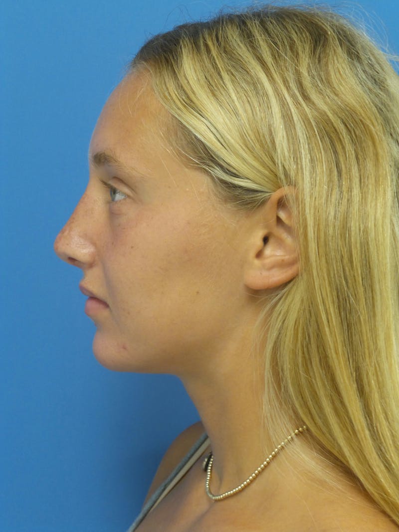 Rhinoplasty Before & After Gallery - Patient 178538 - Image 2