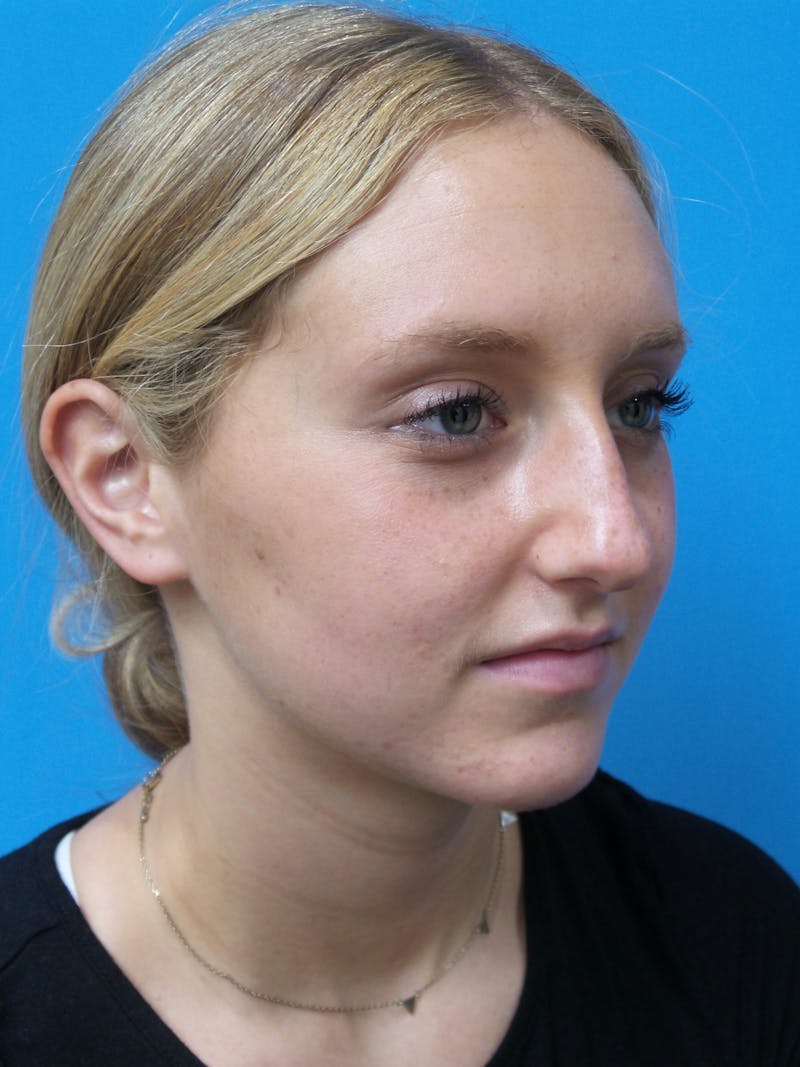 Rhinoplasty Before & After Gallery - Patient 178538 - Image 3